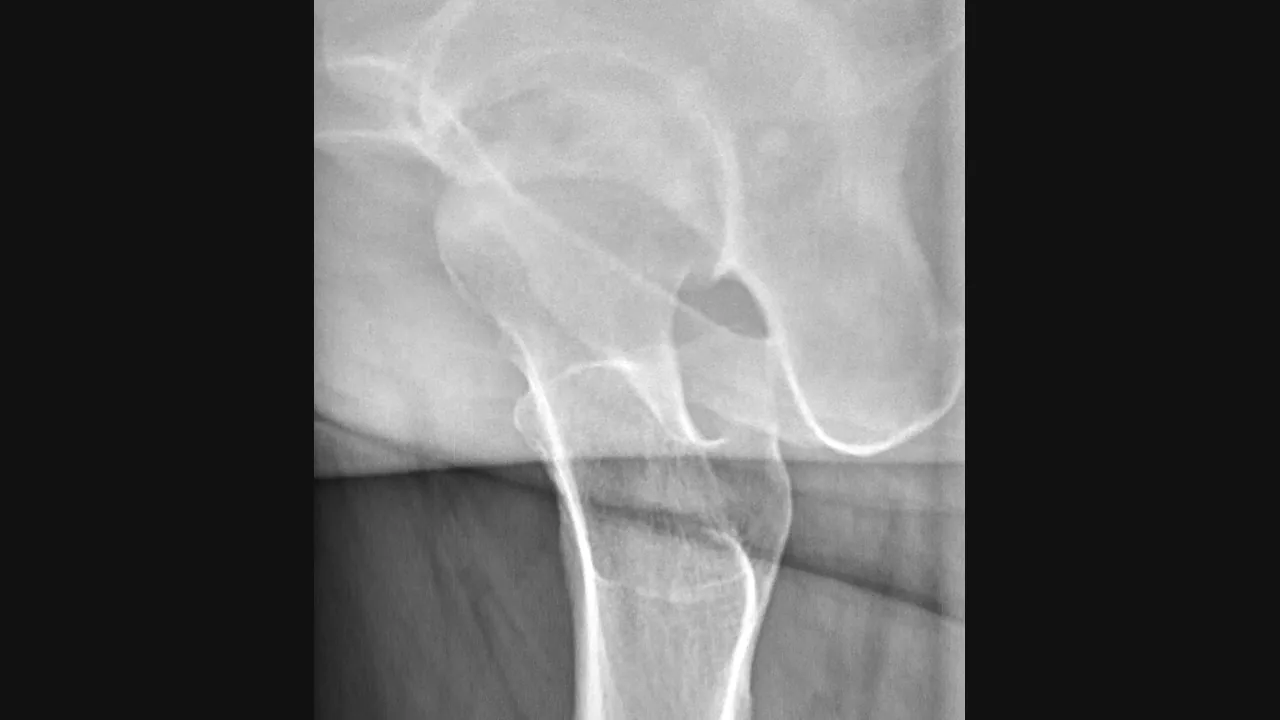 Radiografia lateral de osteonecrose da cabeça do fêmur